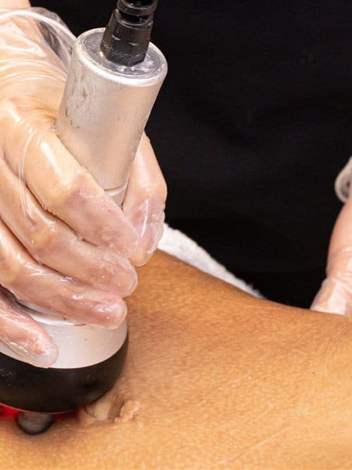 Tratamiento con radiofrecuencia en Carfel, Vigo